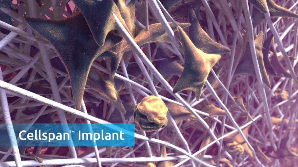 The Cellspan implant in action