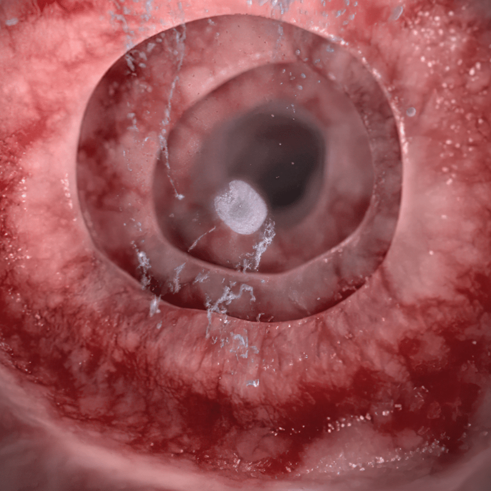 Lialda Treatment for Ulcerative Colitis‎ - XVIVO Scientific Animation