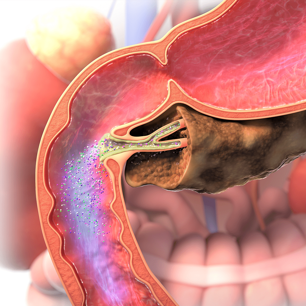 Pancreatic Enzymes