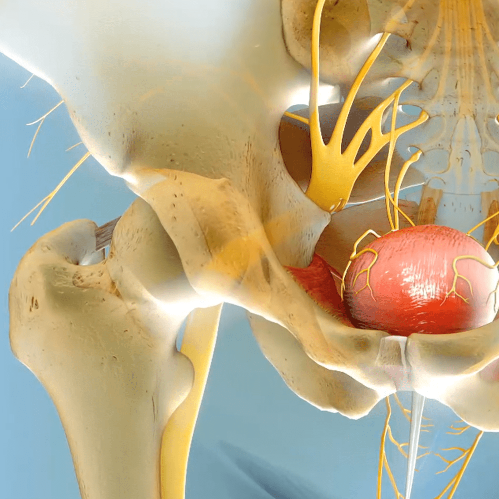 MEDTRONIC SACRAL NEUROMODULATION