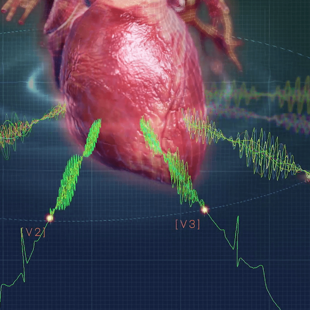 HEART SCIENCES MYOVISTA WAVELET ECG TECHNOLOGY
