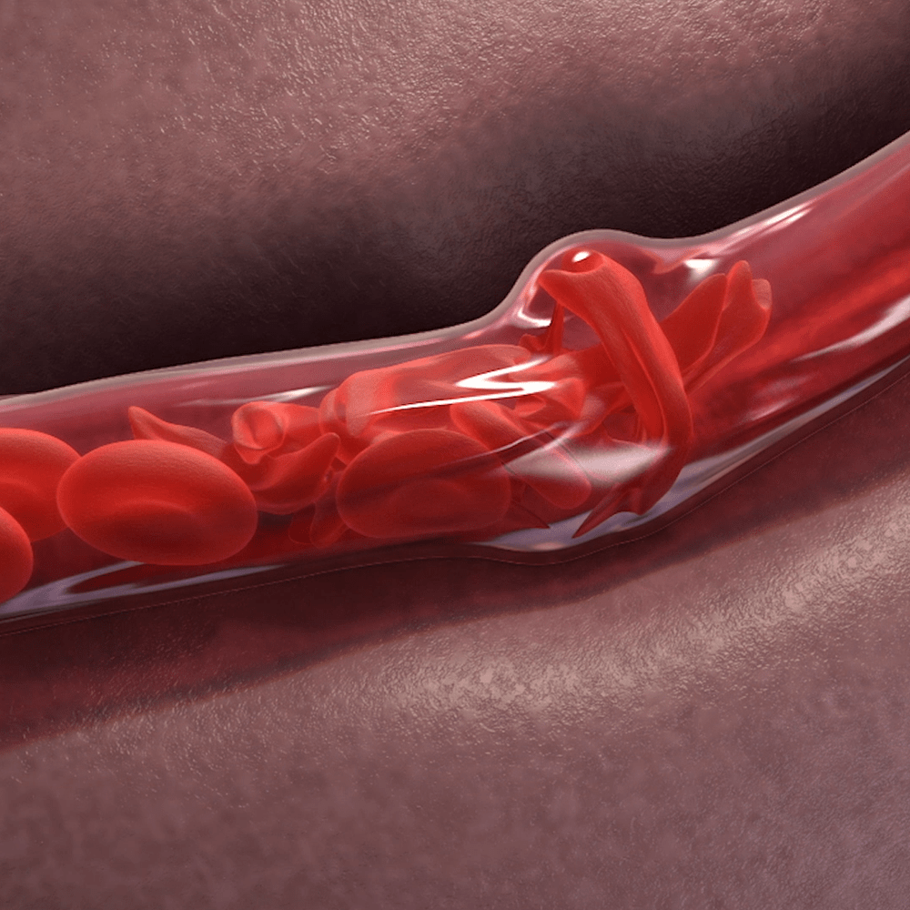 VOXELOTOR AN INVESTIGATIONAL DRUG FOR SICKLE CELL DISEASE